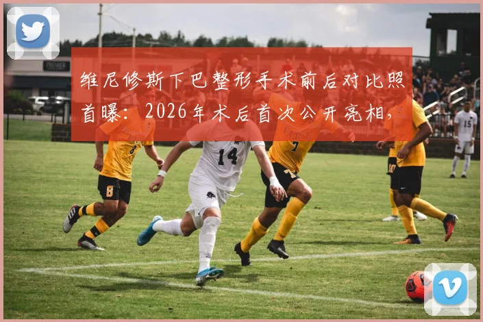 维尼修斯下巴整形手术前后对比照首曝：2026年术后首次公开亮相，状态恢复引关注